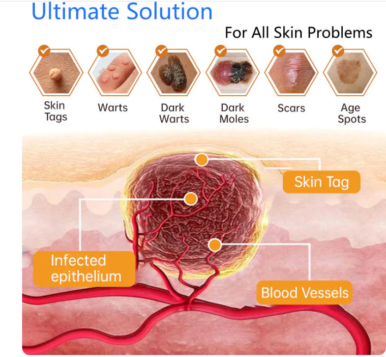 Hot Sale 49% off!🔥Non-Invasive Mole and Wart Removal Laser Pen🔥🔥