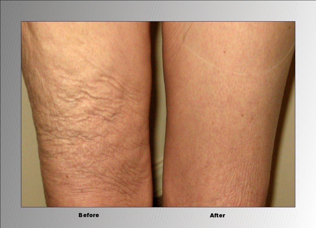 BEST SALE 49% OFF 🔥 Skinnies Instant Thigh Lift Tape