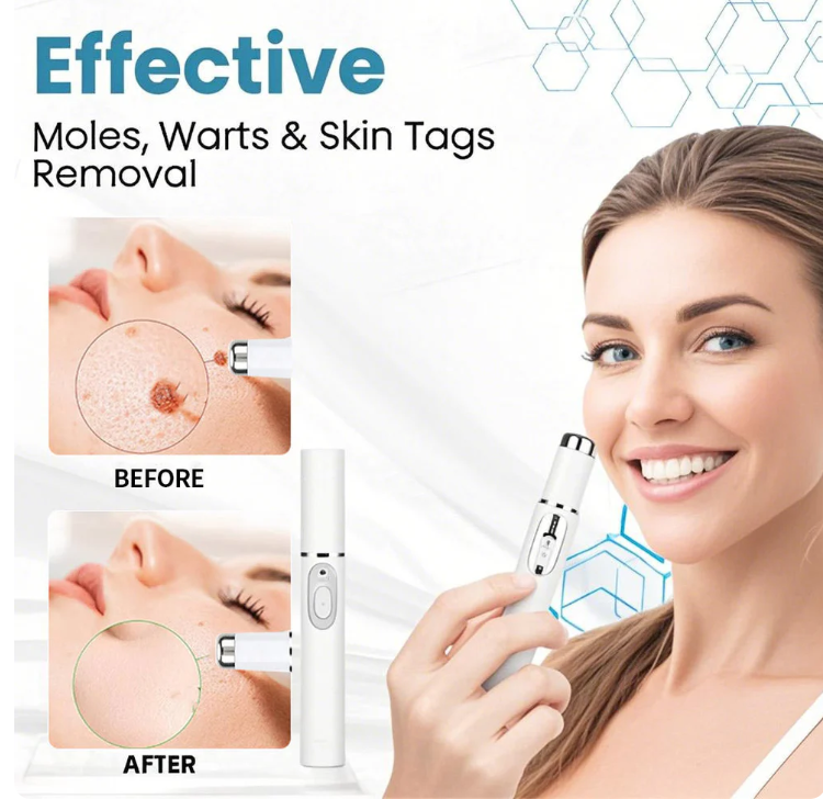 Hot Sale 49% off!🔥Non-Invasive Mole and Wart Removal Laser Pen🔥🔥