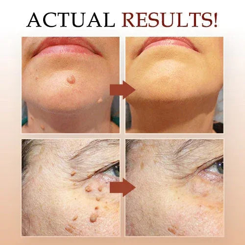 Best Sellers - Tags & Moles Remover——10 pcs (FREE SHIPPING)
