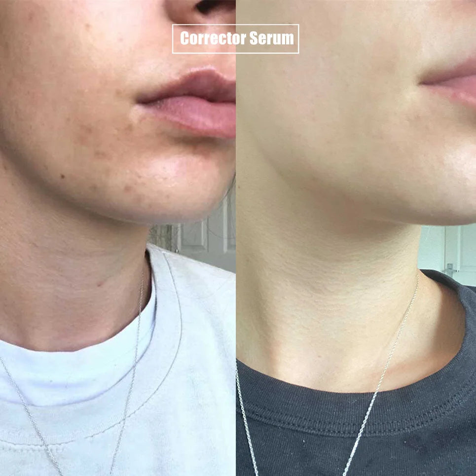 BUY 1 GET 1 FREEš„-Dark Spot Corrector Daily Face Serum