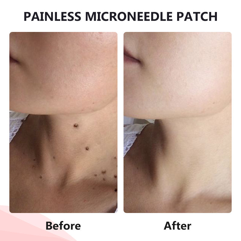 đ„painless micro-patchđ„