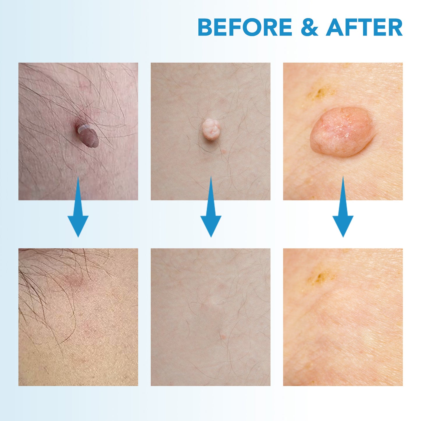 ✨ Painless Skin Tag Remover ✨ — Reveal Smooth, Clear Skin Fast! 🌿