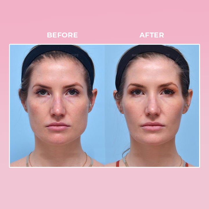 ShapeZ™ V Face Suction Trainer