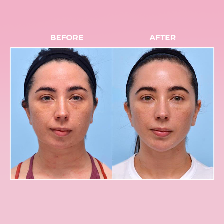 ShapeZ™ V Face Suction Trainer