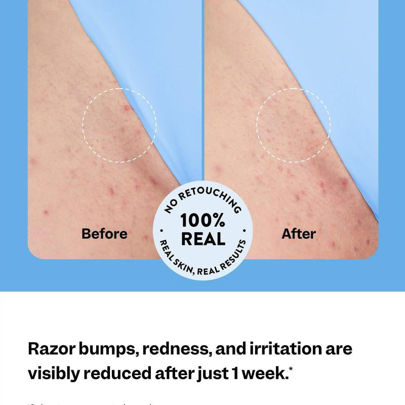 The last day: 49% OFF🩹"Goodbye Underarm Odor!"Smoothing Solution Ingrown Hair Treatment—Glide Your Way to Silky-Smooth, Bump-Free Skin