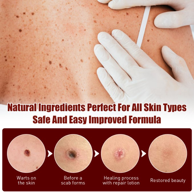 Best Sellers - Tags & Moles Remover——10 pcs (FREE SHIPPING)