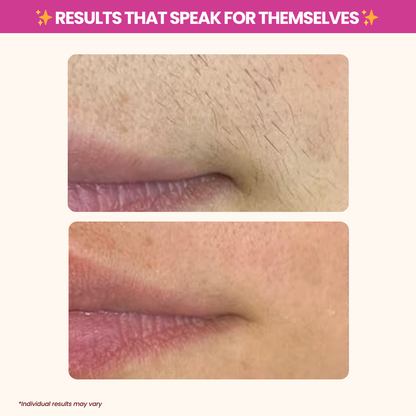 Cyperus Rotundus Oil for Hair Reduction