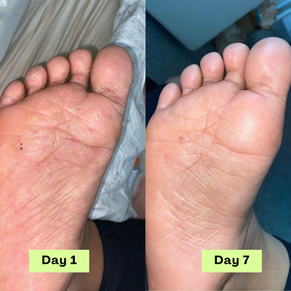 AntiFungal Relief Soap Bar