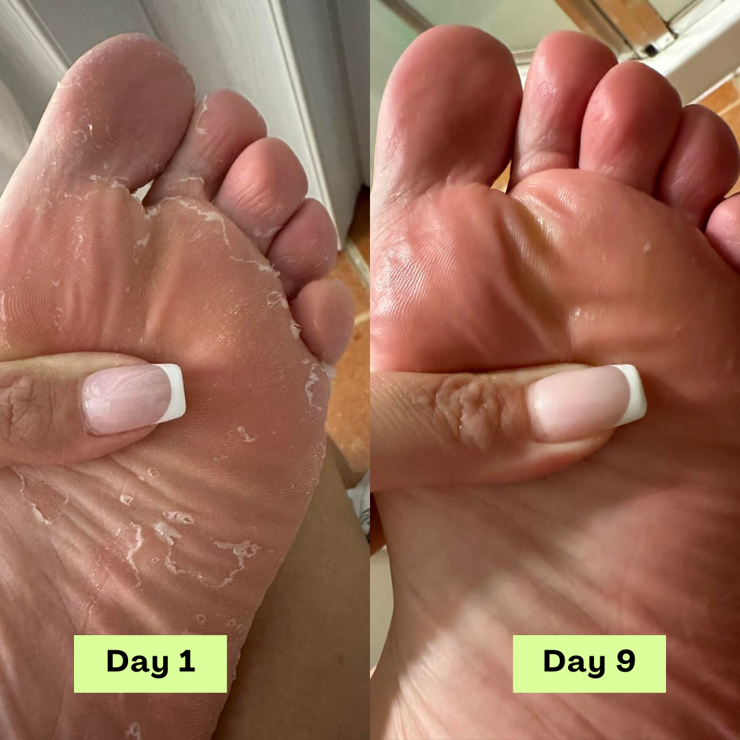 AntiFungal Relief Soap Bar