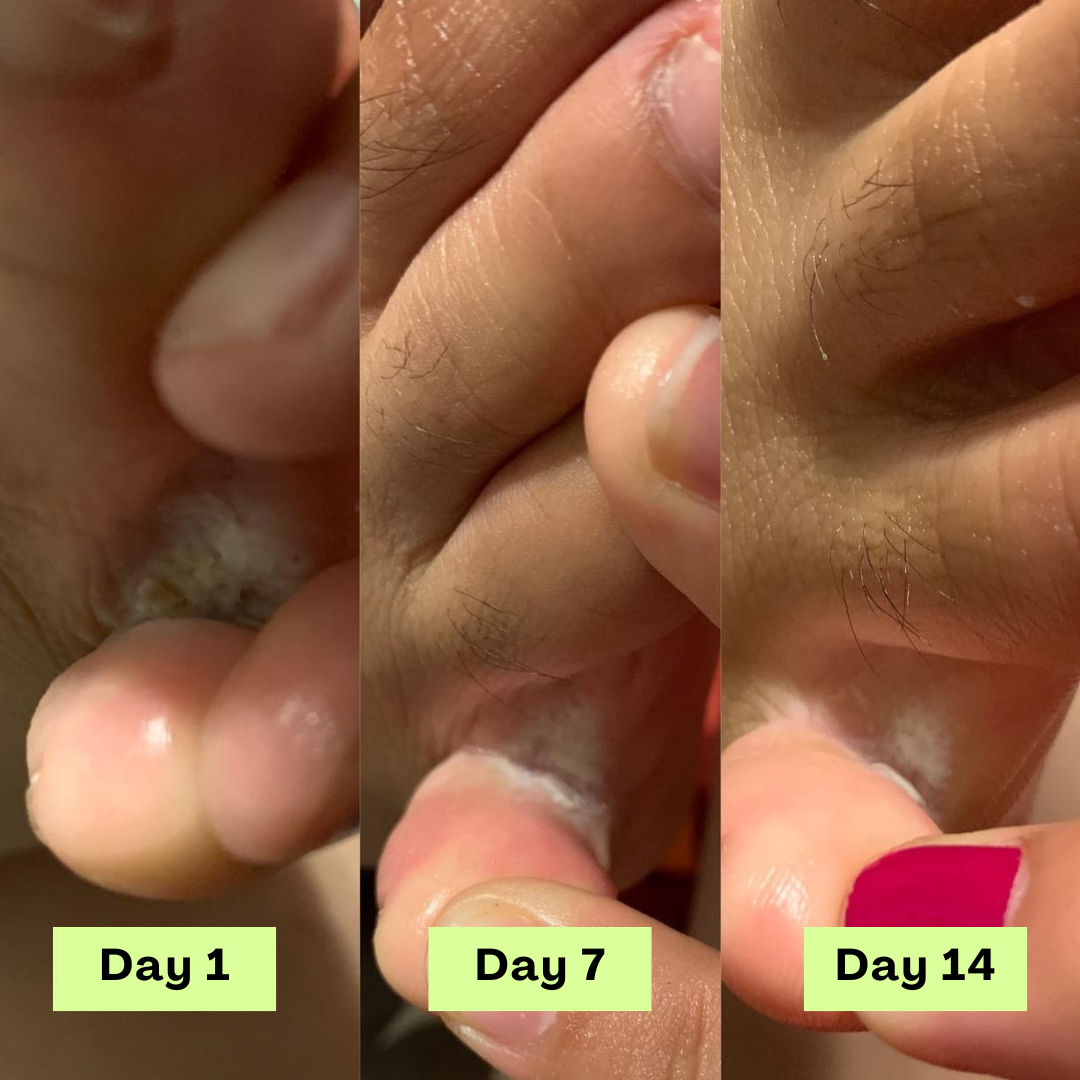 AntiFungal Relief Soap Bar