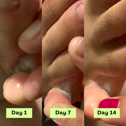 AntiFungal Relief Soap Bar