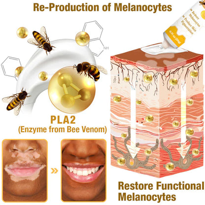 💥 49% OFF Limited Time! Bee Venom Vitiligo Treatment Cream 🐝 | Restore Your Skin's Natural Glow 🌟