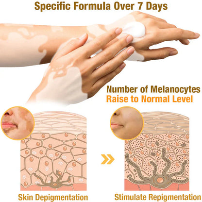 💥 49% OFF Limited Time! Bee Venom Vitiligo Treatment Cream 🐝 | Restore Your Skin's Natural Glow 🌟