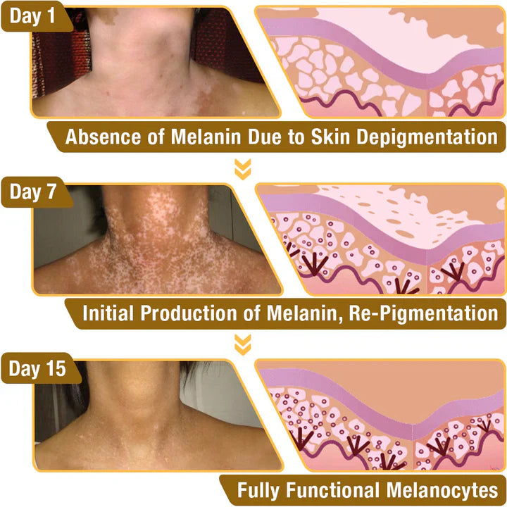 💥 49% OFF Limited Time! Bee Venom Vitiligo Treatment Cream 🐝 | Restore Your Skin's Natural Glow 🌟
