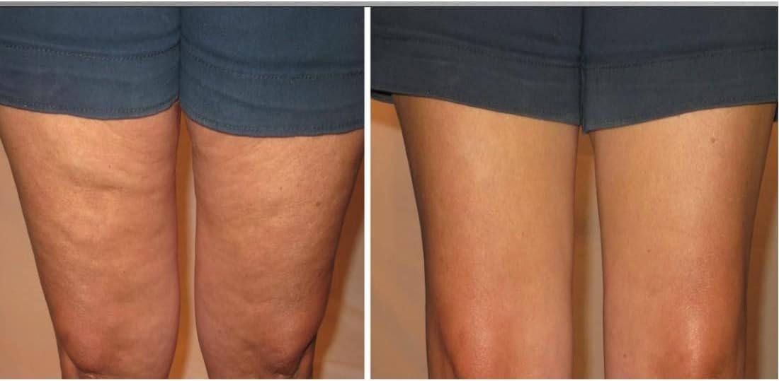 BEST SALE 49% OFF 🔥 Skinnies Instant Thigh Lift Tape