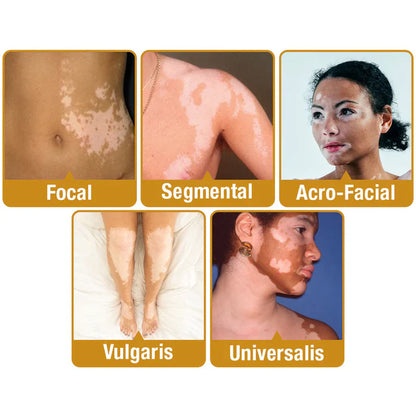 💥 49% OFF Limited Time! Bee Venom Vitiligo Treatment Cream 🐝 | Restore Your Skin's Natural Glow 🌟
