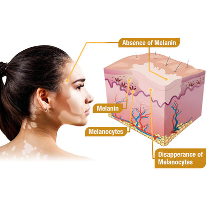 💥 49% OFF Limited Time! Bee Venom Vitiligo Treatment Cream 🐝 | Restore Your Skin's Natural Glow 🌟
