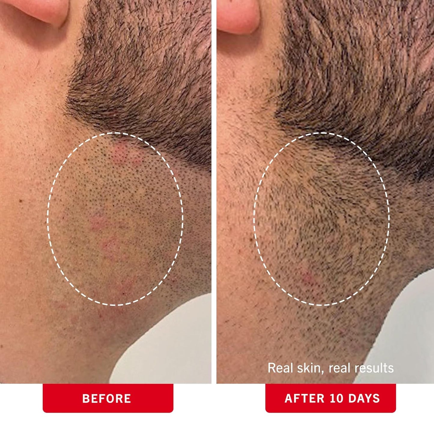 The last day: 49% OFF🩹"Goodbye Underarm Odor!"Smoothing Solution Ingrown Hair Treatment—Glide Your Way to Silky-Smooth, Bump-Free Skin