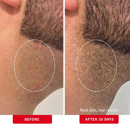 The last day: 49% OFF🩹"Goodbye Underarm Odor!"Smoothing Solution Ingrown Hair Treatment—Glide Your Way to Silky-Smooth, Bump-Free Skin