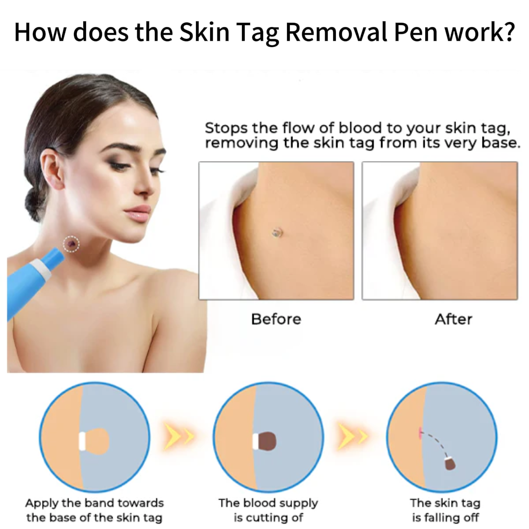 ✨ Painless Skin Tag Remover ✨ — Reveal Smooth, Clear Skin Fast! 🌿