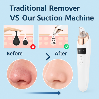🔥 Best-Selling Pore Vacuum Just Got 49% OFF – Limited Stock Only!