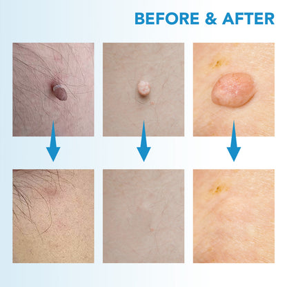 ✨ Painless Skin Tag Remover ✨ — Reveal Smooth, Clear Skin Fast! 🌿