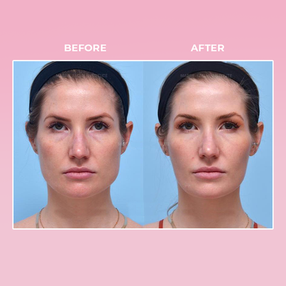 ShapeZ™ V Face Suction Trainer