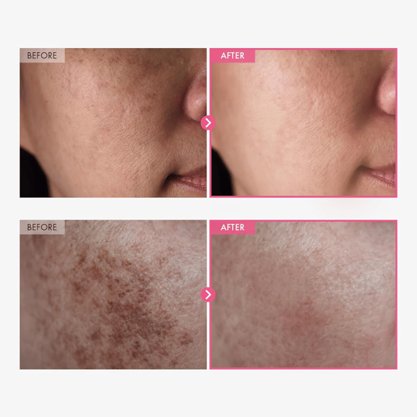 HOT SALE 49% OFF - Arbutin 7% + Tranexamic Acid 4% Cream