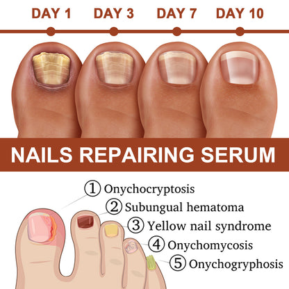 [Last Day 49% OFF] 7-day nail growth and strengthening serum
