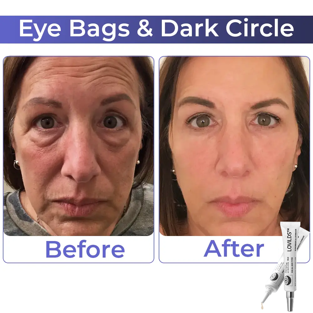 Buy 1 Get 1 Free  49%off🔥Eyebag Cream